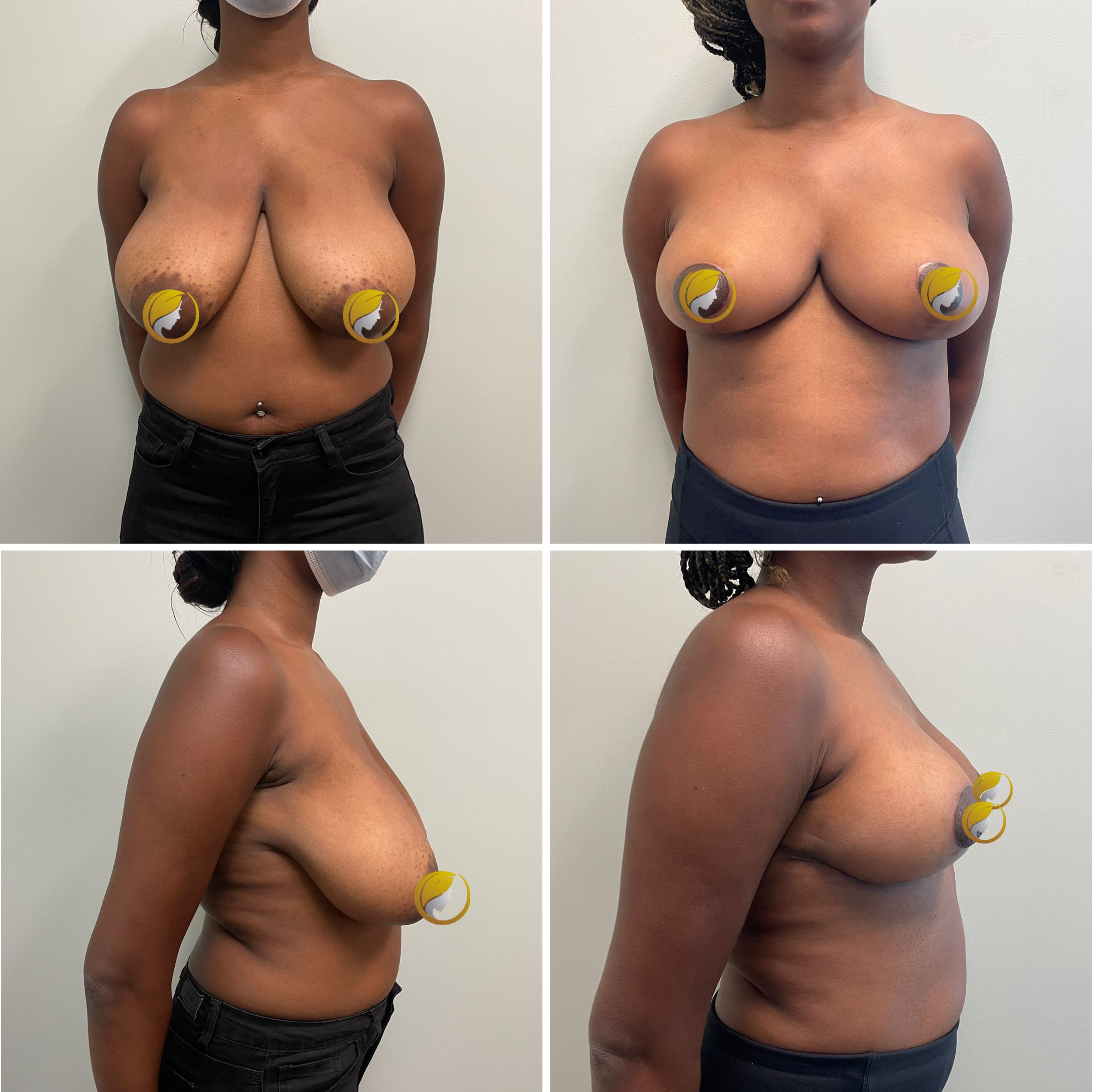 Breast Reduction Surgery by Dr. Bonett 