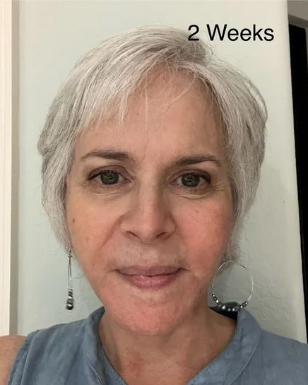 Neck Lift & Facial Fat Transfer Week 2