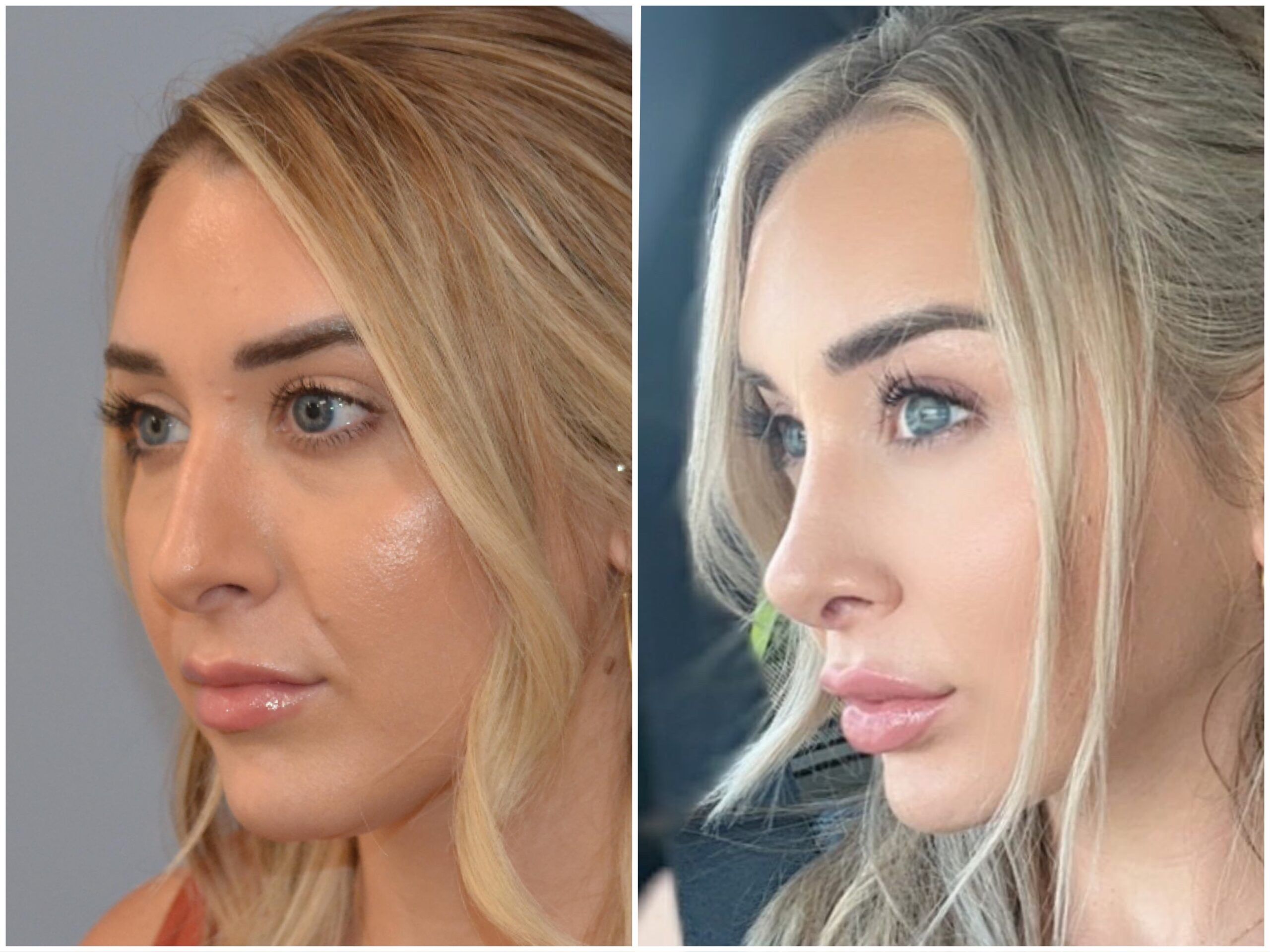 Neck Lipo with Skin Tightening by Dr. Baccaro