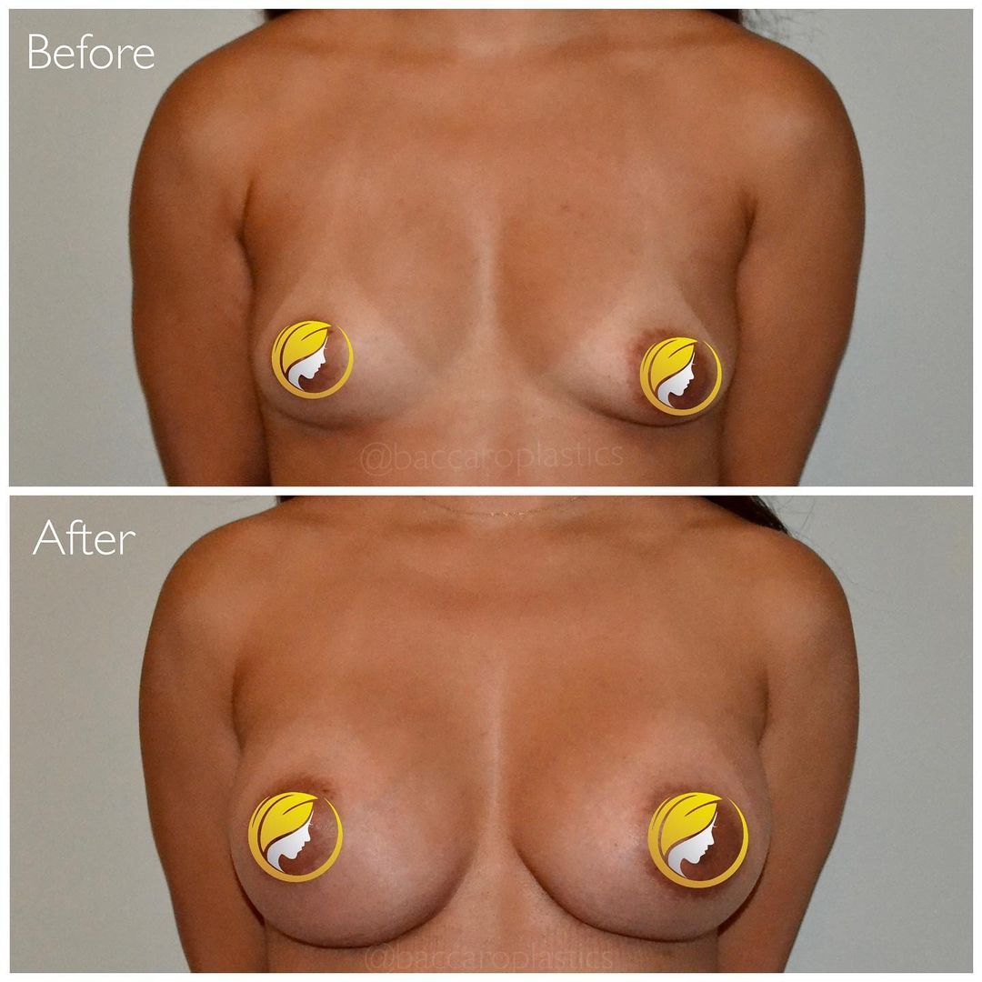 Hybrid Breast Augmentation by Dr. Baccaro