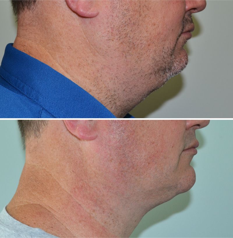 baccaro neck precisiontx 1