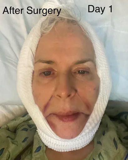 Neck Lift & Facial Fat Transfer Day of Surgery