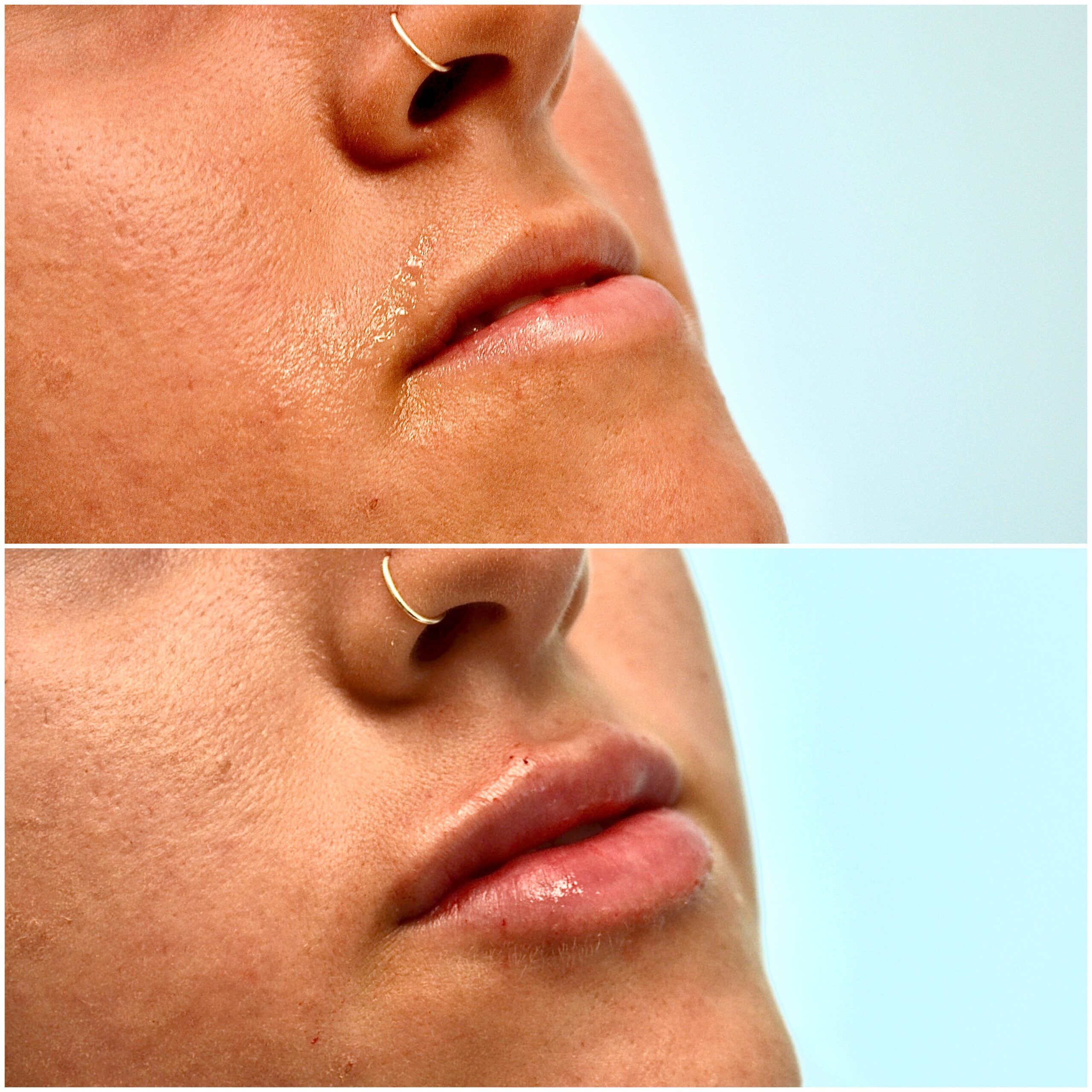 Lip Filler by Dr. Baccaro