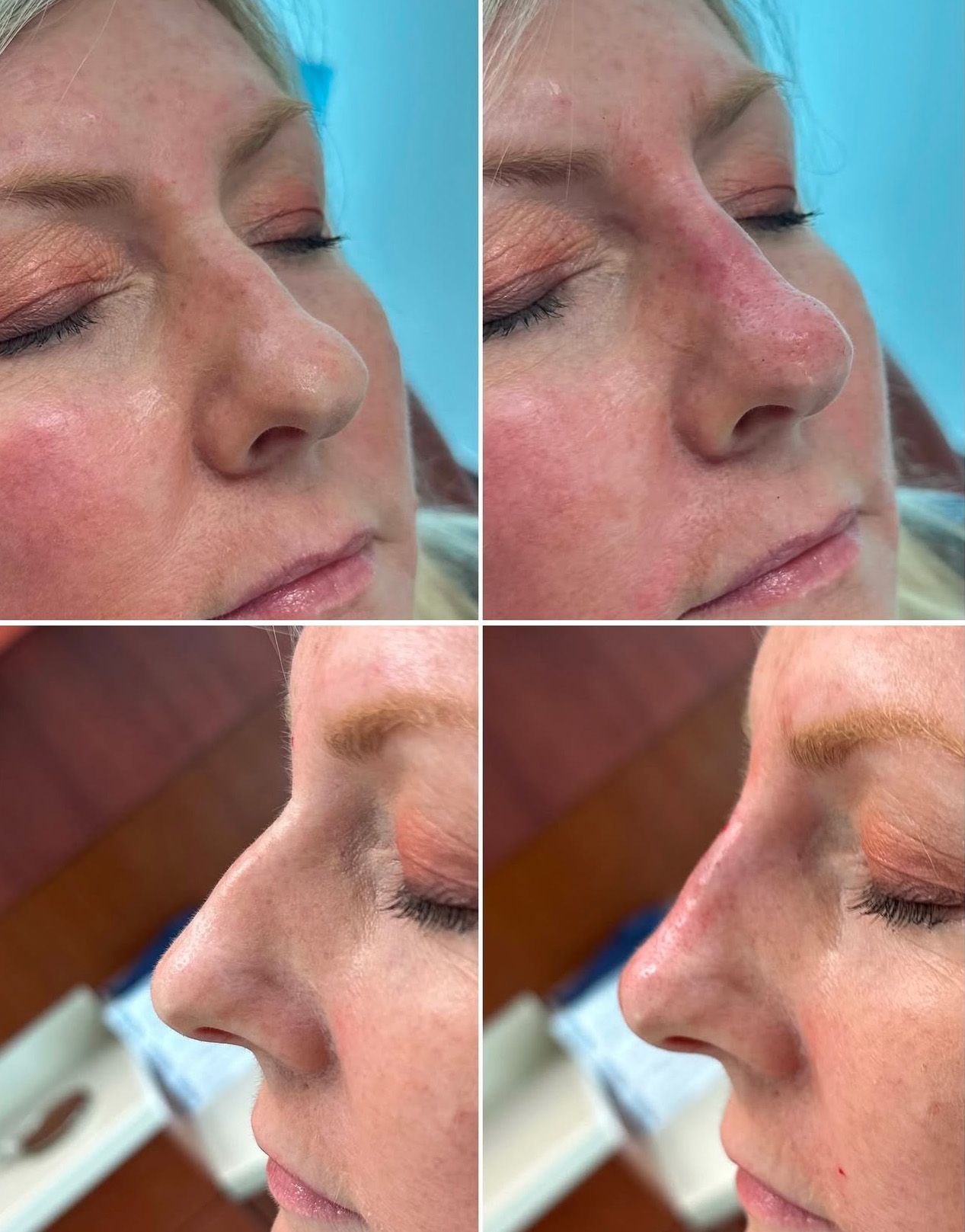 Liquid Rhinoplasty by Dr. Baccaro