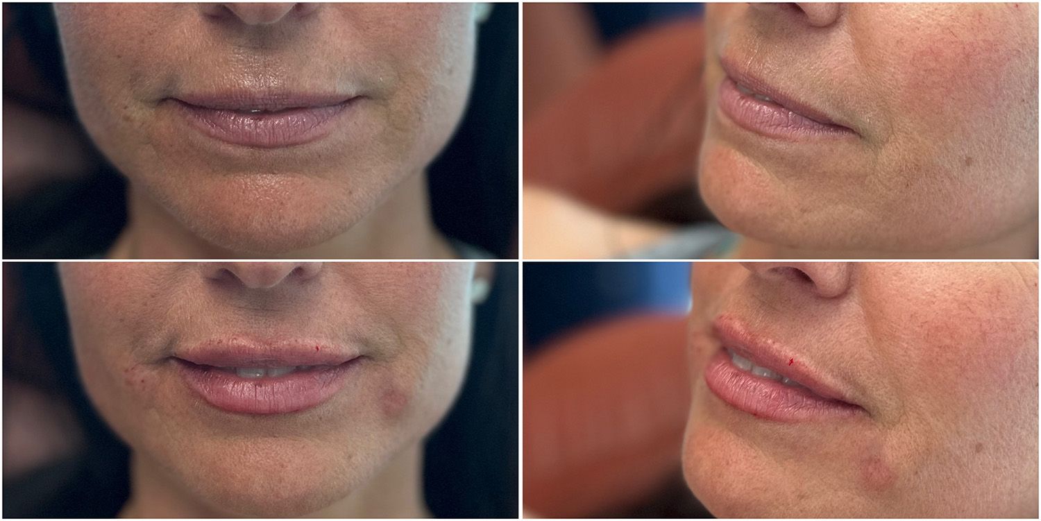 Lip Filler by Dr. Baccaro