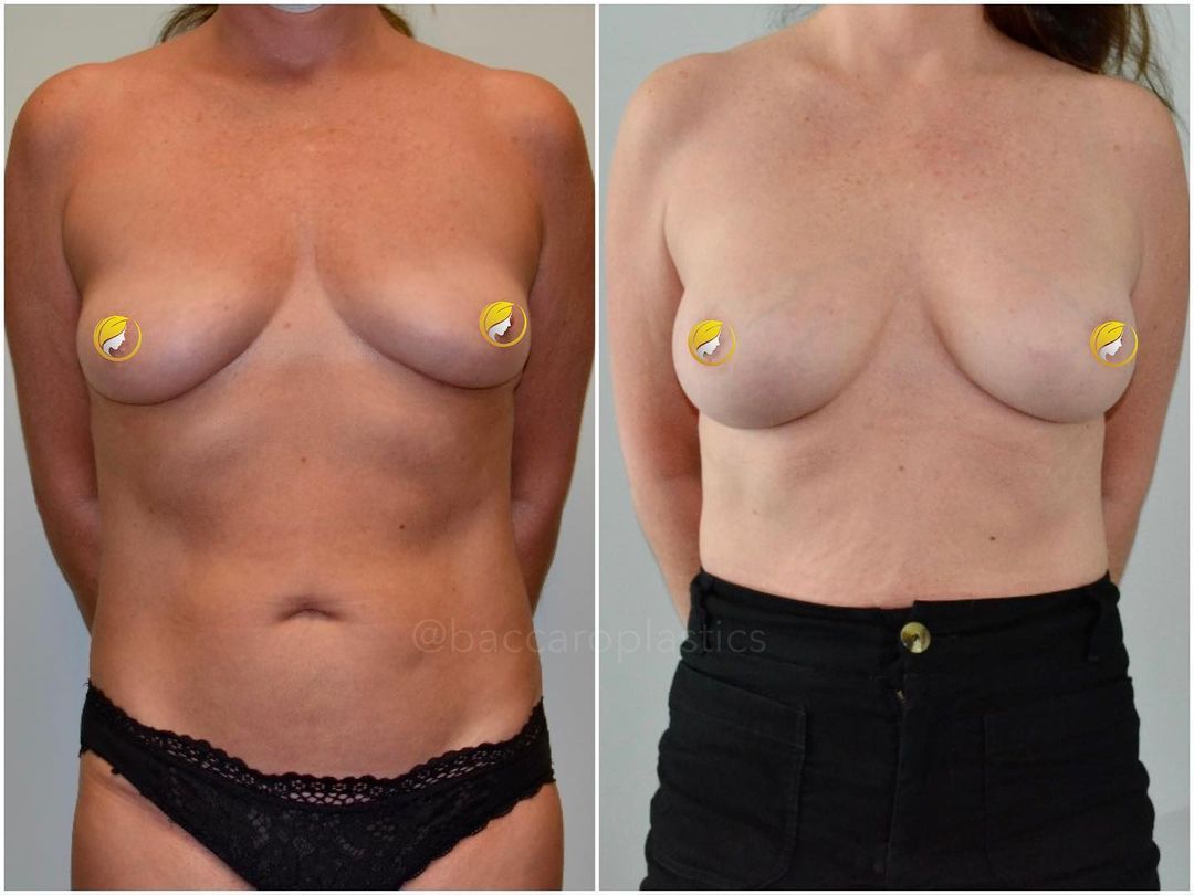 Hybrid Breast Augmentation by Dr. Baccaro