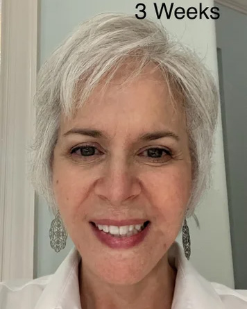 Neck Lift & Facial Fat Transfer Week 3