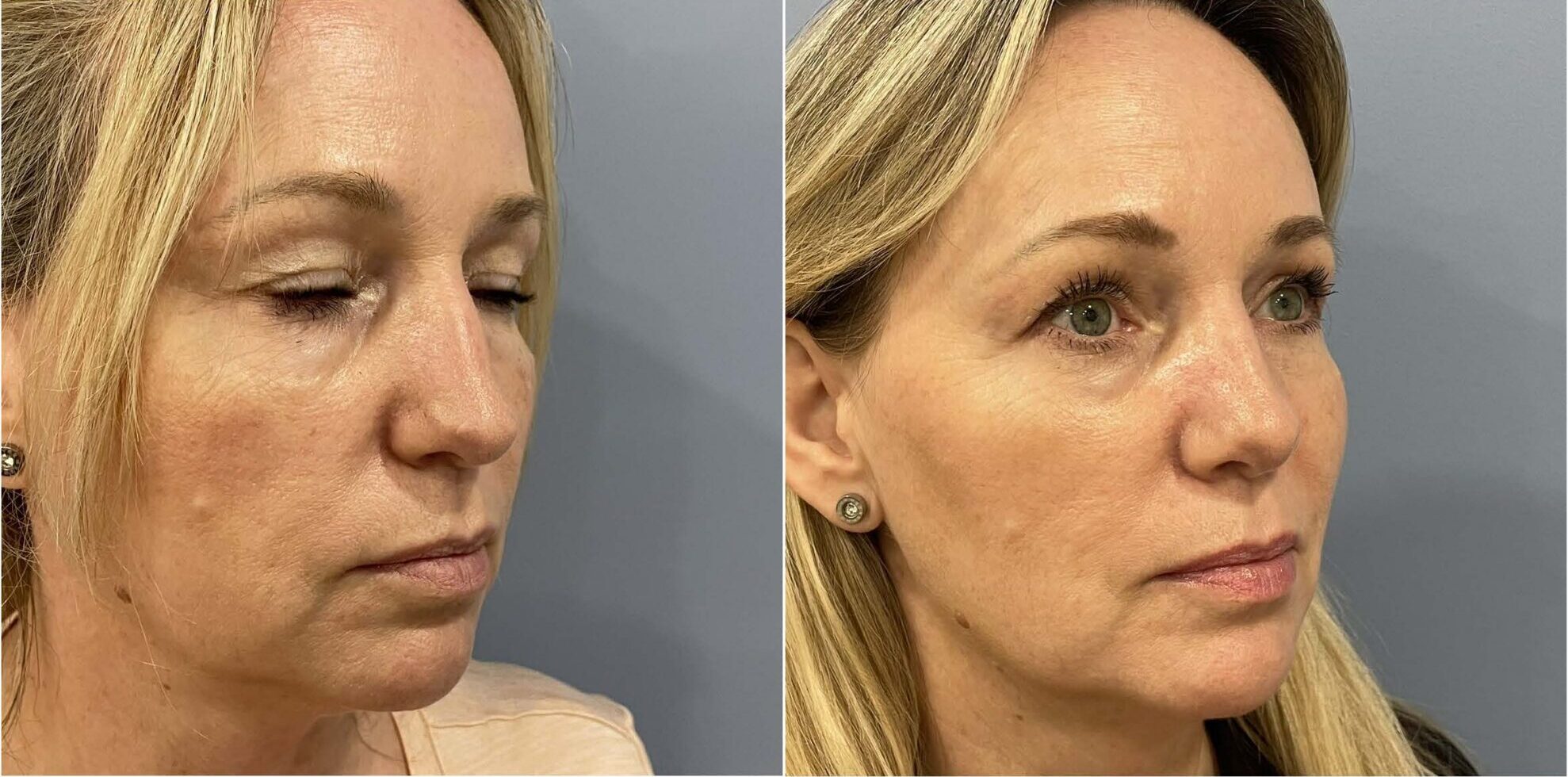 Septoplasty before and after result