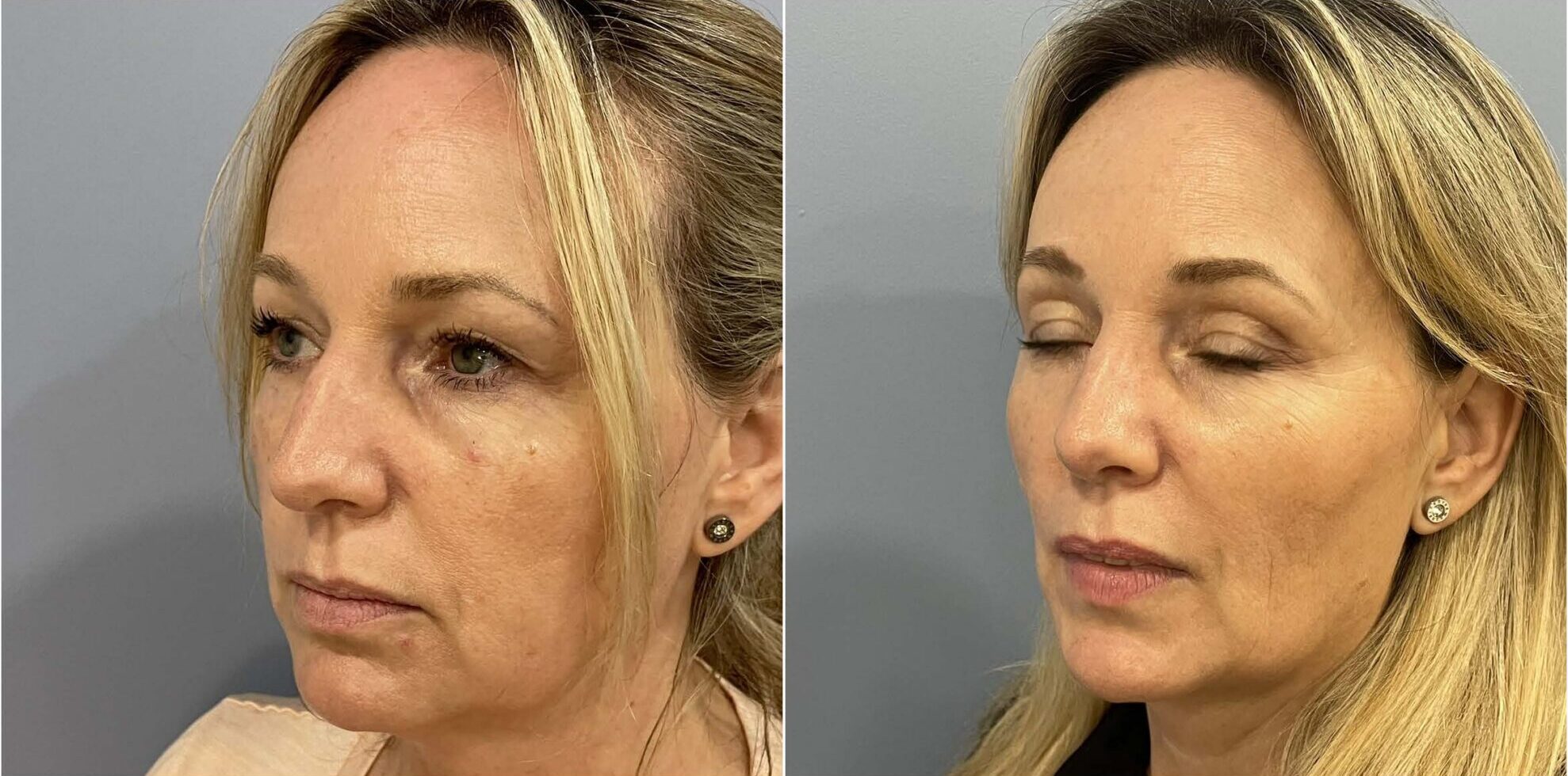 Septoplasty before and after result