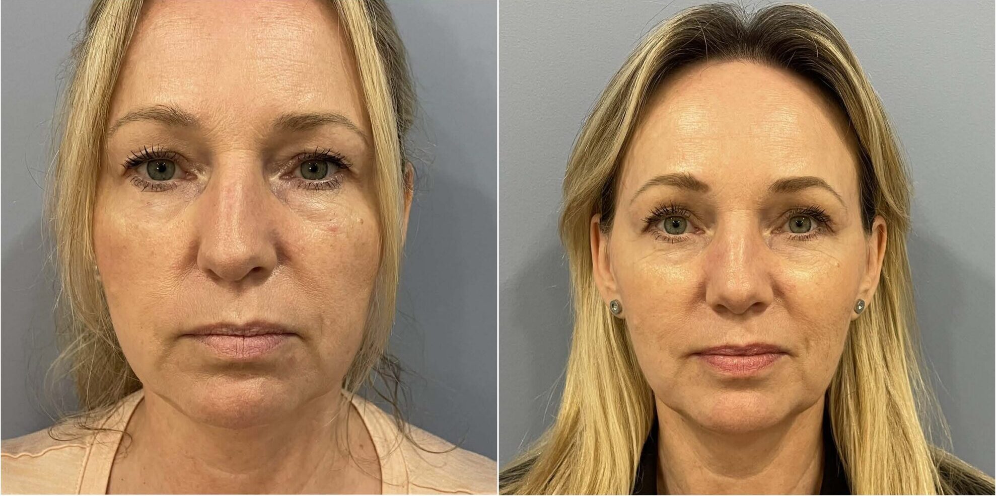 Septoplasty before and after result