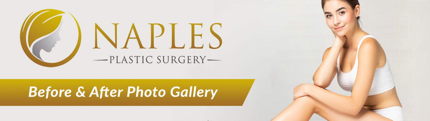 Visit the Naples Plastic Surgery before and after Gallery
