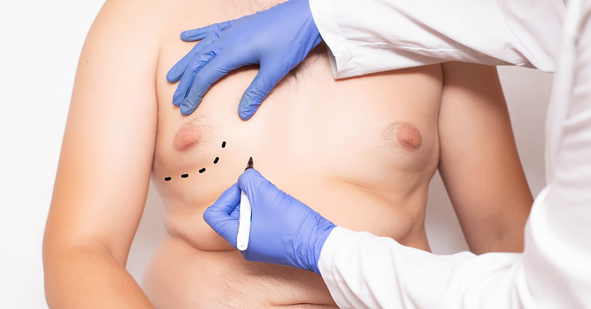 空山基作品集 The Gynoids GM Dr. Gardner on Gynecomastia | Naples Plastic Surgery