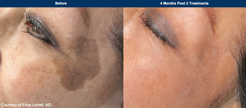 Improved Skin Tone with UltraClear Laser