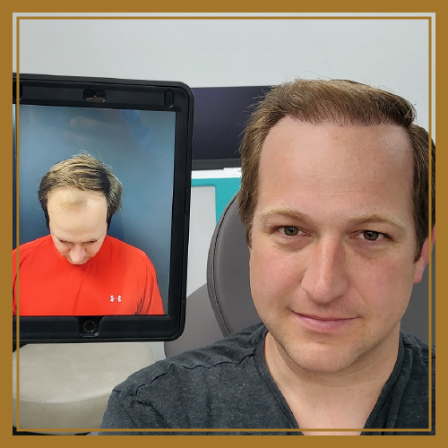 Before and After Naples Hair restoration image