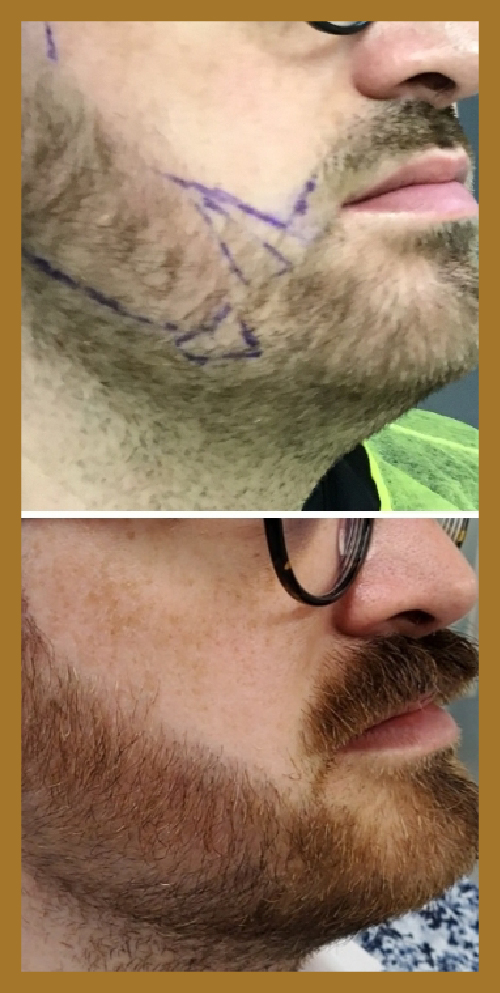 beard growth hair restoration