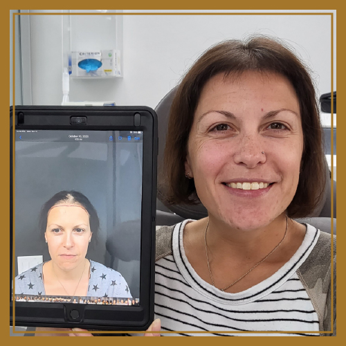 Woman's before and after naples hair restoration image.