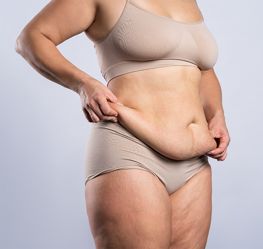 Panniculectomy Surgery at Naples Plastic Surgery