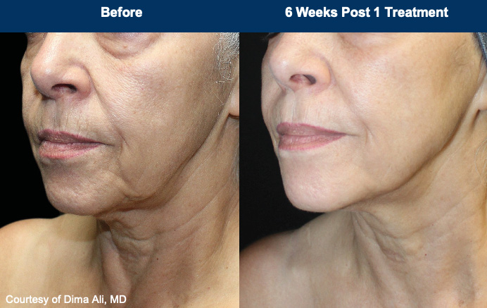 Reduction in Wrinkles with UltraClear Before and After