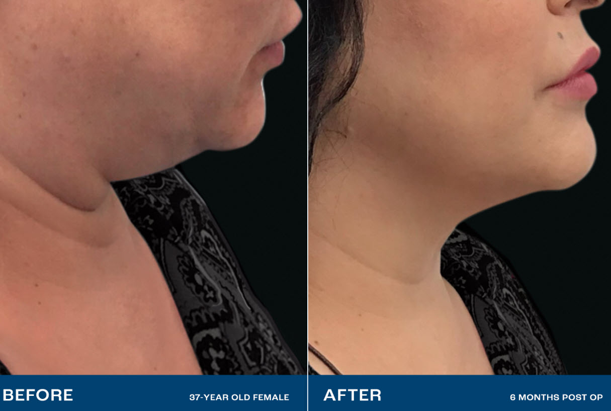 Renuvion skin tightening before and after image