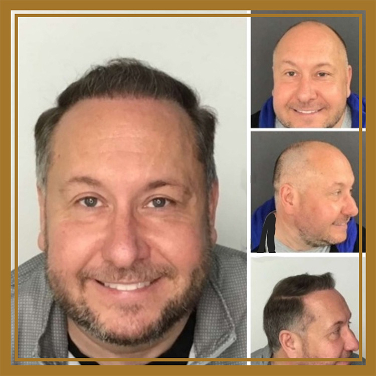 Hair Restoration by Dr. Wisiorek