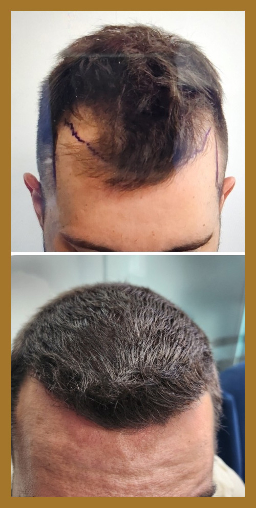 Hair Restoration by Dr. Wisiorek