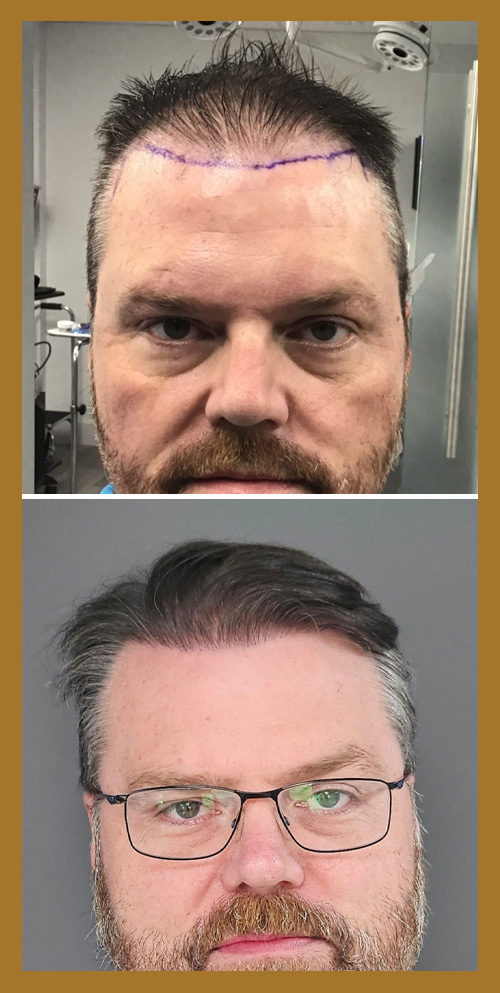 Hair Restoration by Dr. Wisiorek
