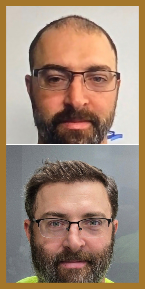 Hair Restoration by Dr. Wisiorek