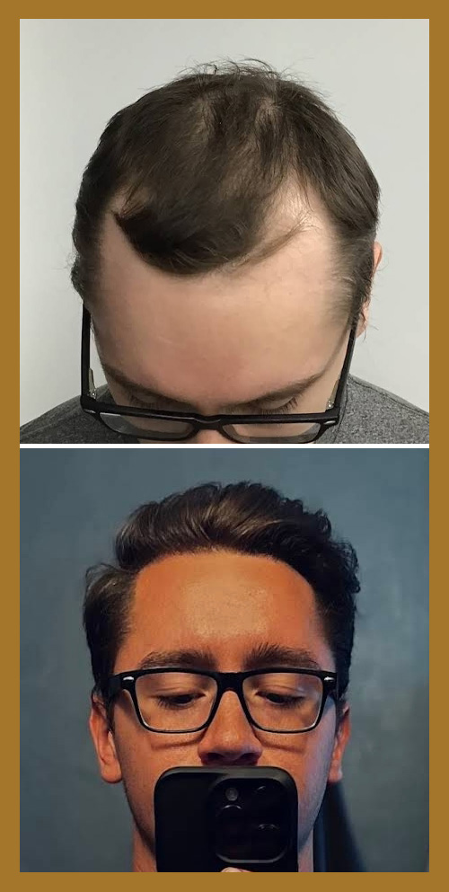 Hair Restoration by Dr. Wisiorek
