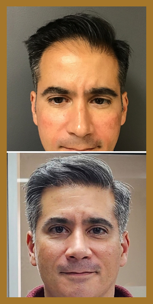 Hair Restoration by Dr. Wisiorek
