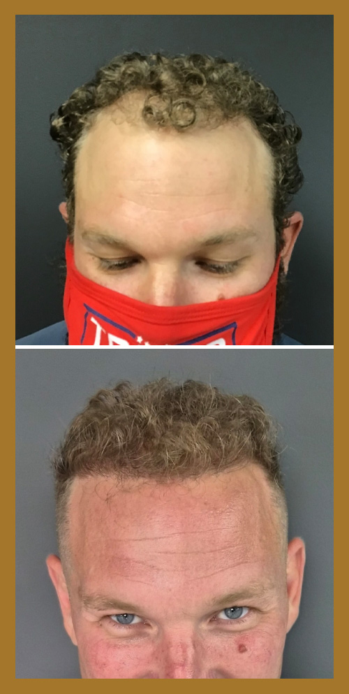 Hair Restoration by Dr. Wisiorek