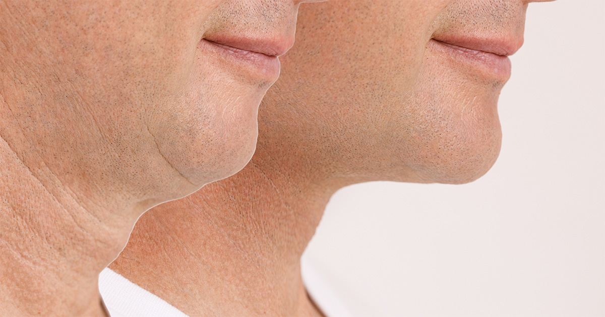 Your Male Neck Lift Procedure