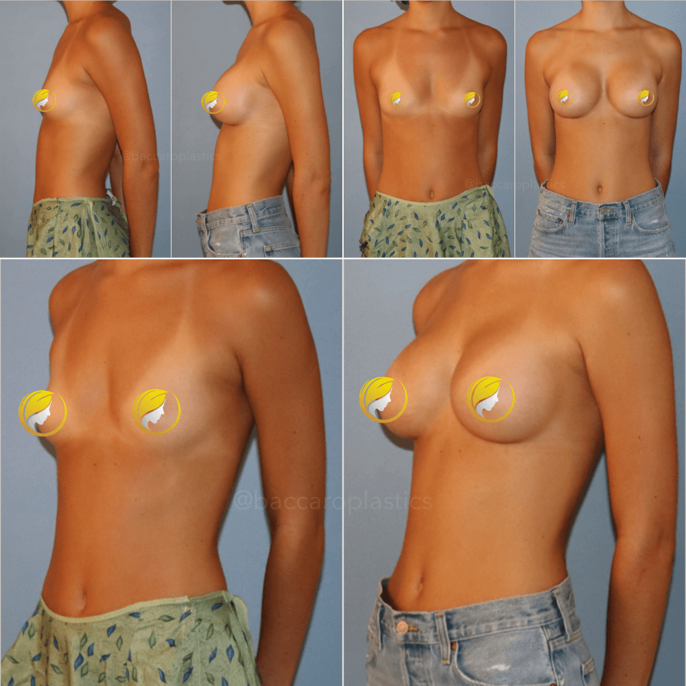 Hybrid Breast Augmentation