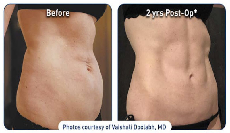 Renuvion skin tightening before and after image