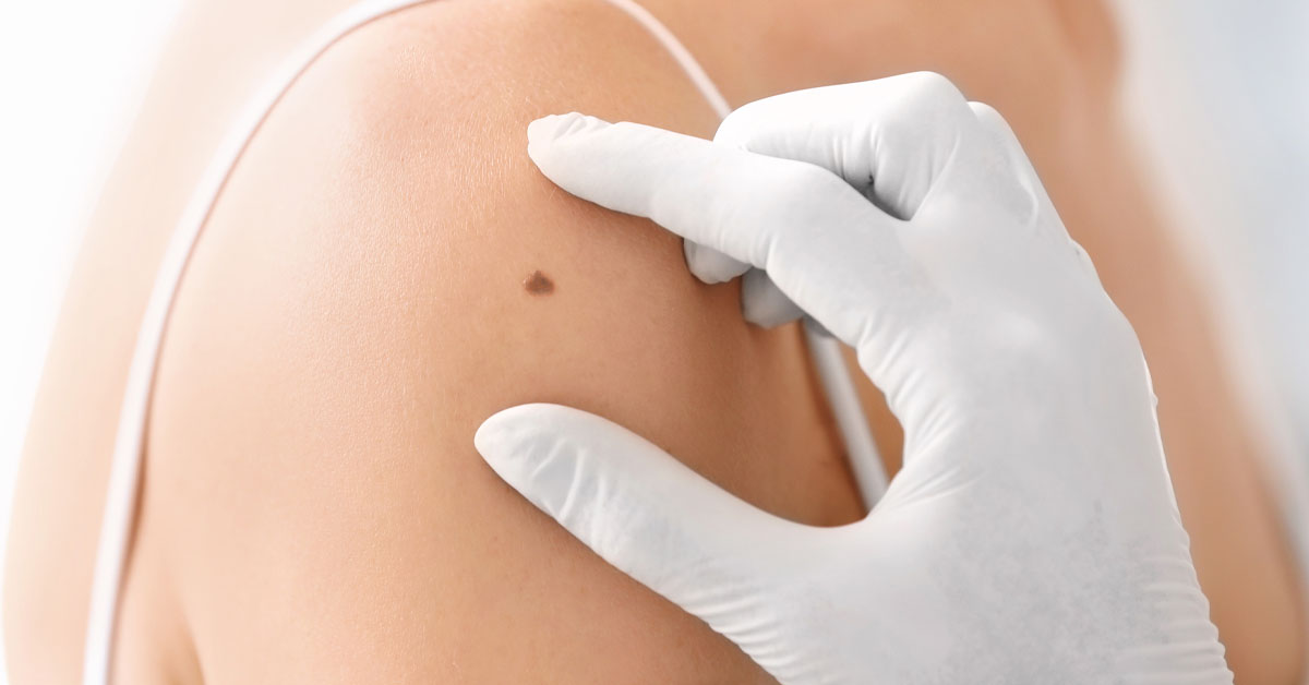 mohs reconstruction surgery at naples plastic surgery