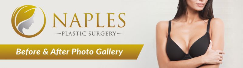 Visit the Naples Plastic Surgery before and after Gallery