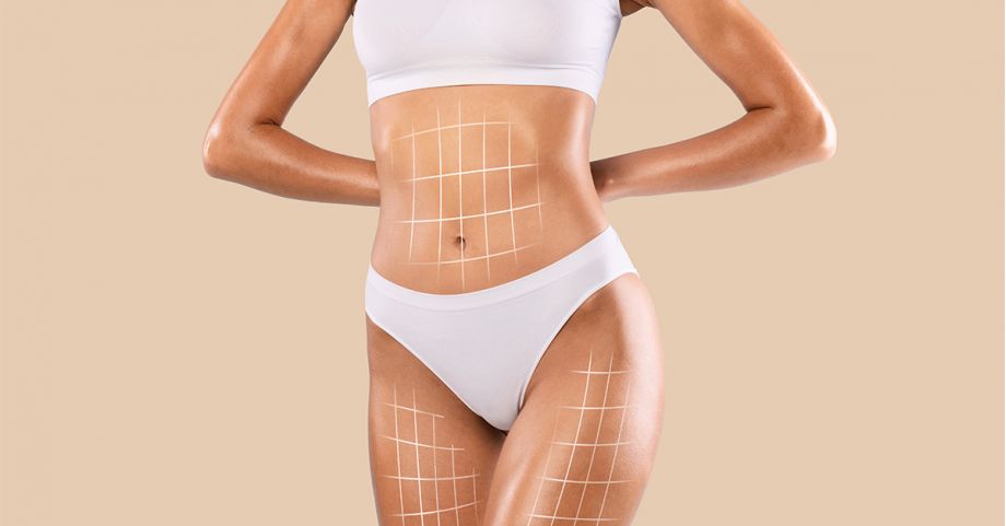 Benefits of Liposuction