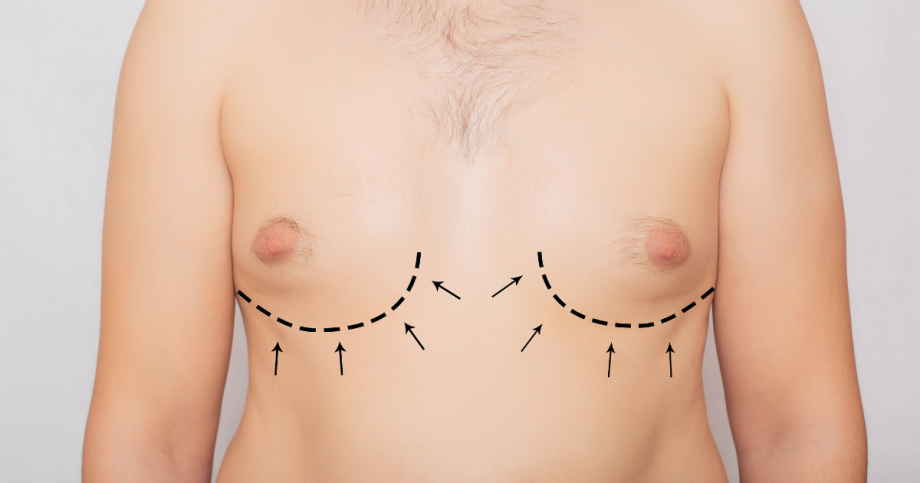 Gynecomastia