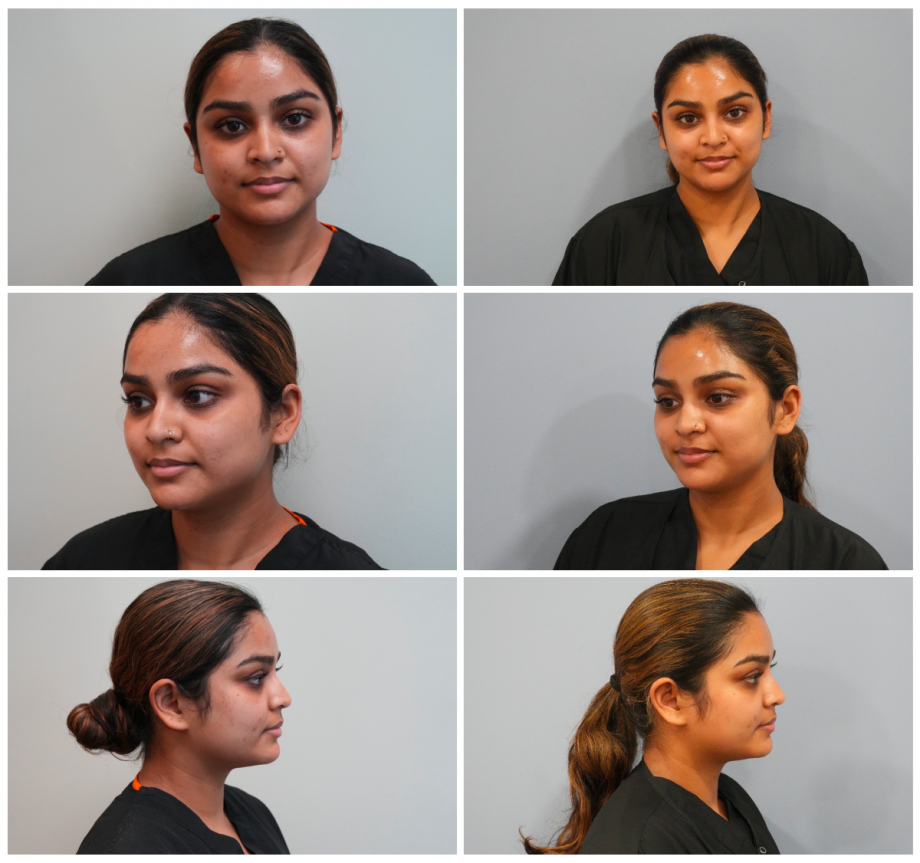 What is Ultraclear Laser